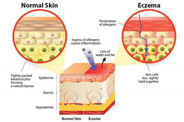 Genetic Test - Differences between normal skin and eczema